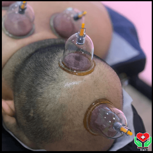 حجامت در منزل ، حجامت در خانه ، حجامت سر در تهران ؛ حجامت سر در شمال ، شرق ، غرب و جنوب تهران و کرج _ حجامت از سر در جوانان ، مردان ، سالمندان