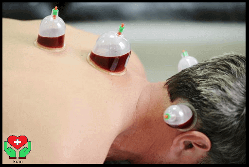 حجامت در منزل ، حجامت پشت گوش در منزل ، حجامت خانگی پشت گوش ، حجامت ماستوئید در خانه ، حجامت درمانی از پشت گوش
