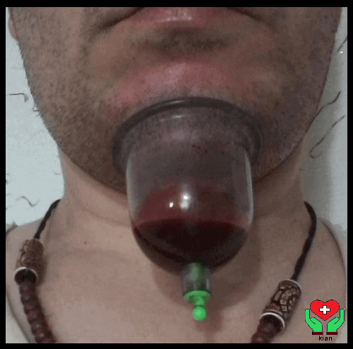 حجامت زیر چانه در منزل ، فواید حجامت خانگی زیر چانه ، درمان لکنت با حجامت زیر چانه در خانه ، حجامت در منزل ،